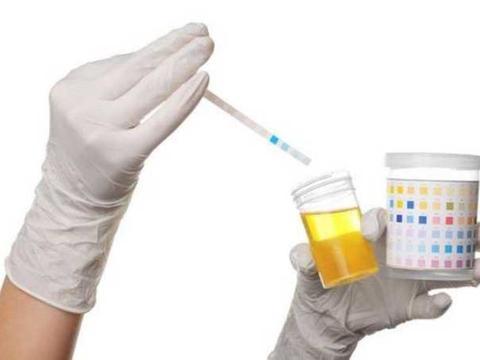 检查尿酸需要做哪些项目?